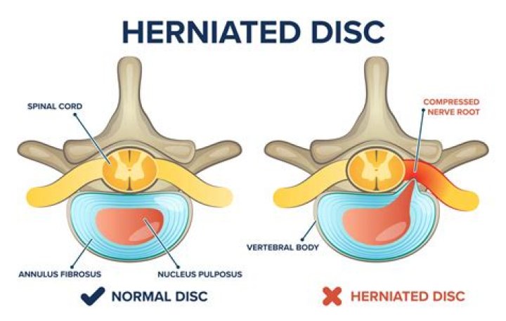 How does a herniated disc affect the spinal cord?