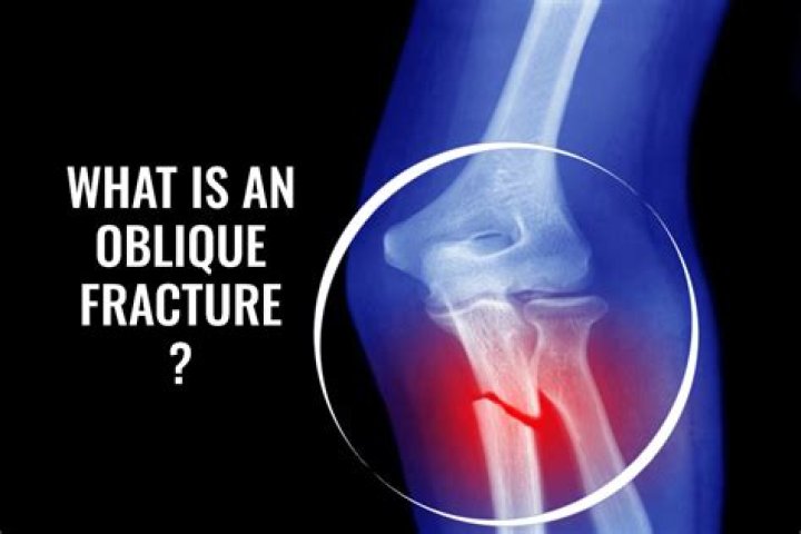 How does a oblique fracture occur?