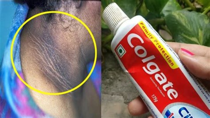 How does toothpaste get rid of dark neck?