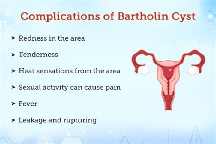 How is an infected Bartholin cyst treated?