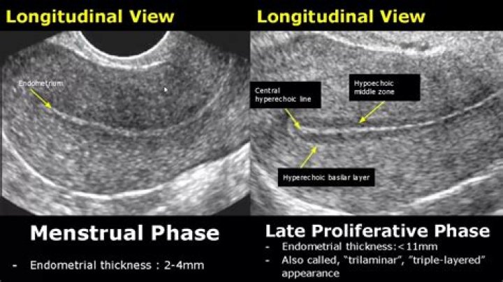 How is endometrial ultrasound measured?