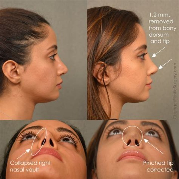 How long after rhinoplasty can I get Botox?