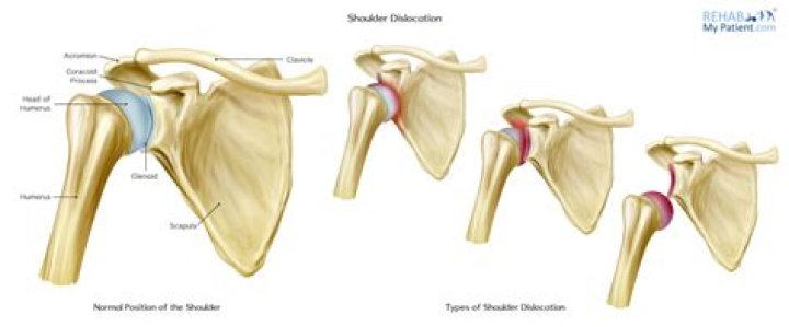 How long do you keep a dislocated shoulder in a sling?