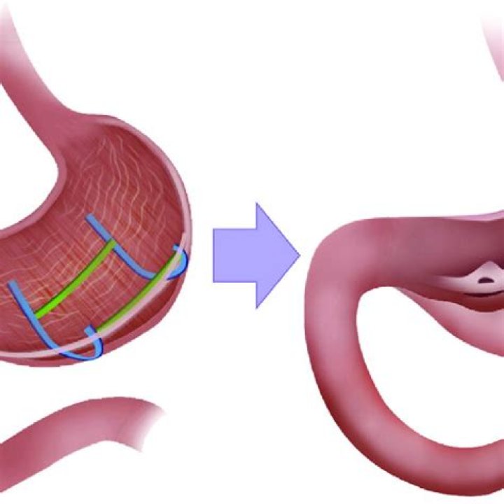 How long does gastric plication last?
