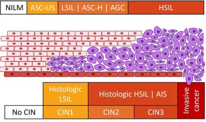 How long does it take for HSIL to turn into cancer?