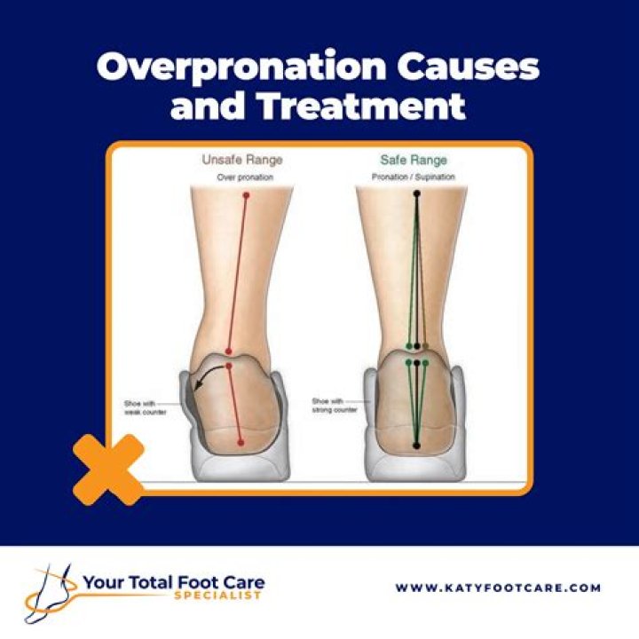 How long does it take to fix Overpronation?