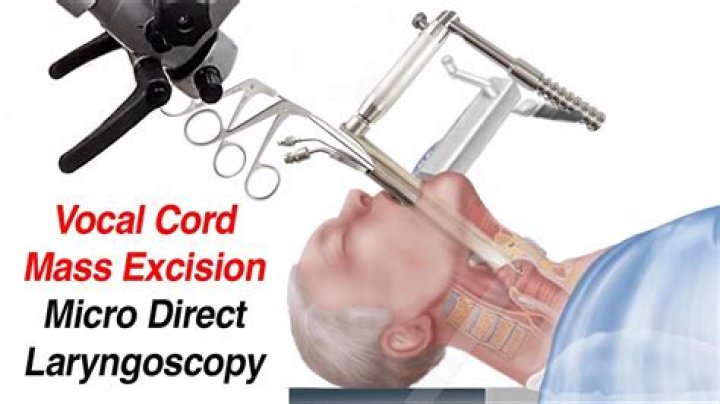 How long does it take to heal from vocal cord surgery?