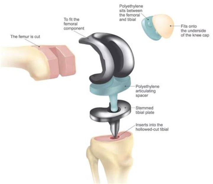 How many components are implanted during a total knee arthroplasty?