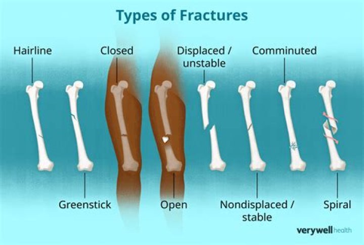 How many pages is fracture?