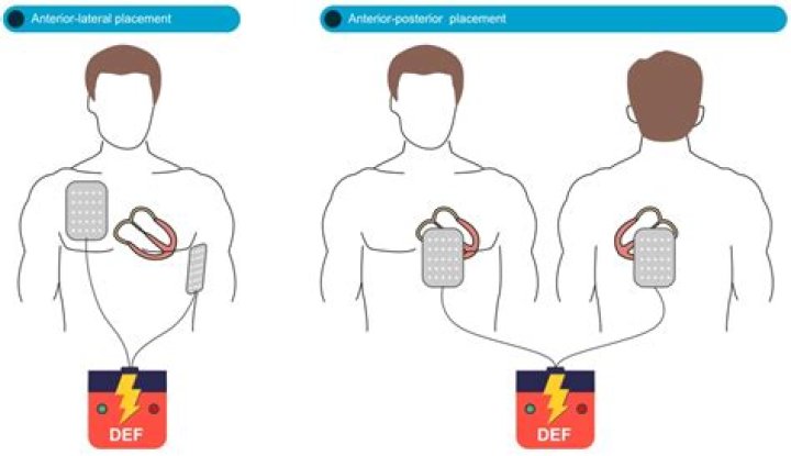 How much current is in a defibrillator?