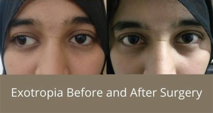 How much does Exotropia surgery cost?