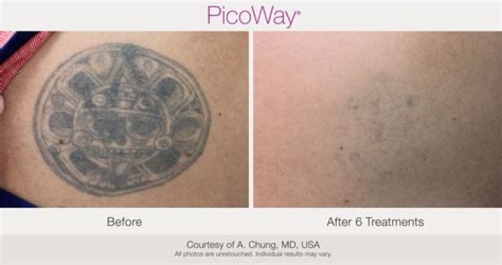 How much does PicoWay tattoo removal cost?