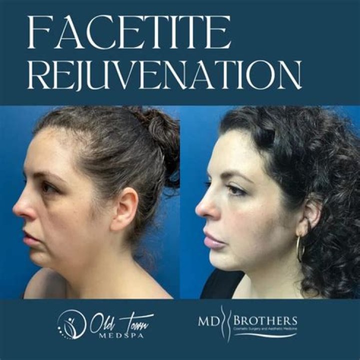 How much is a FaceTite procedure?