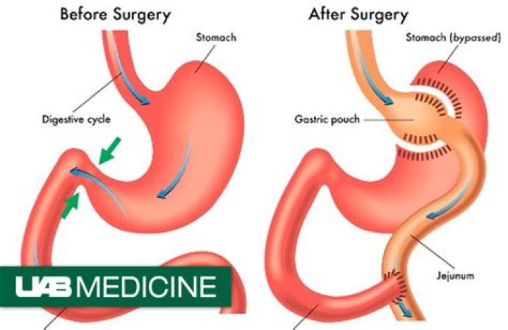 How much is bariatric surgery out of pocket?