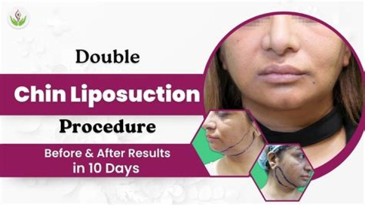 How much is Lipo in the chin?