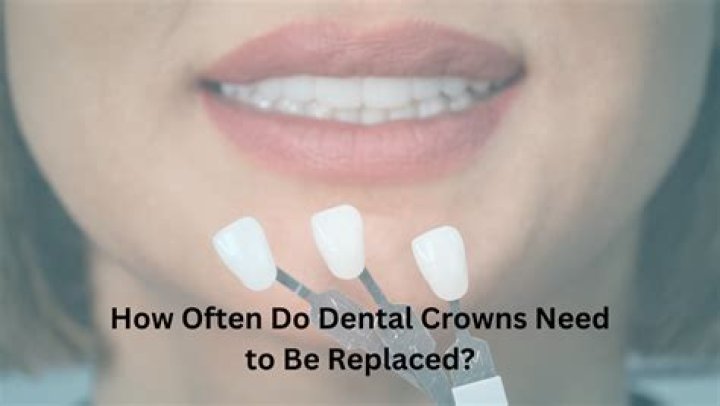 How often do dental crowns need to be replaced?