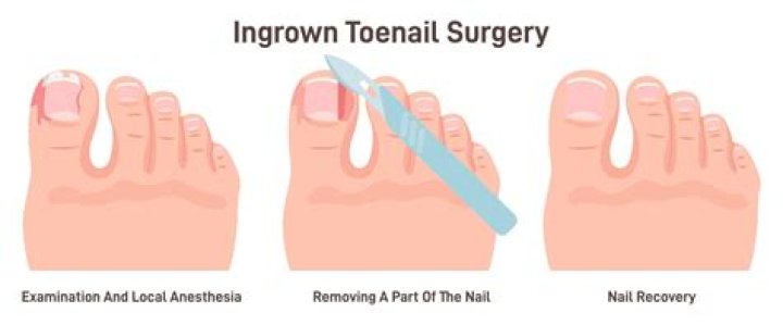 How painful is removing an ingrown toenail?