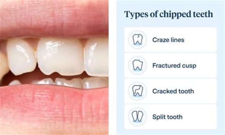 How serious is a chipped tooth?