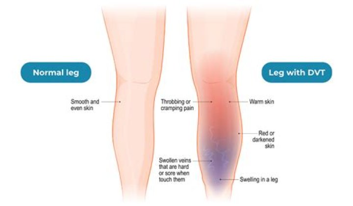 How serious is a DVT in the leg?