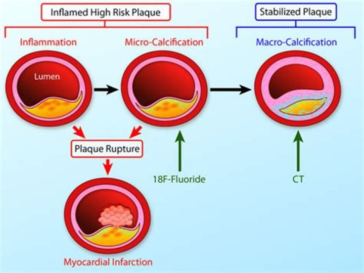 How serious is calcification of the heart?