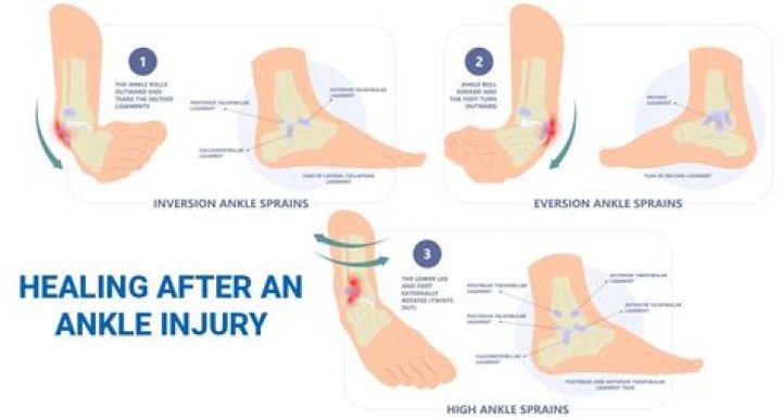 How soon after ankle sprain can I rehab?