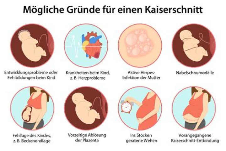 In welcher Woche wird ein wunschkaiserschnitt gemacht?