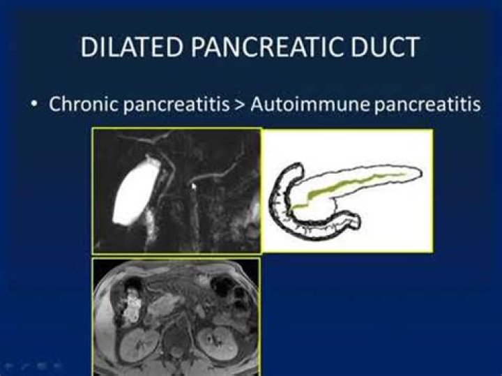Is a dilated pancreatic duct serious?