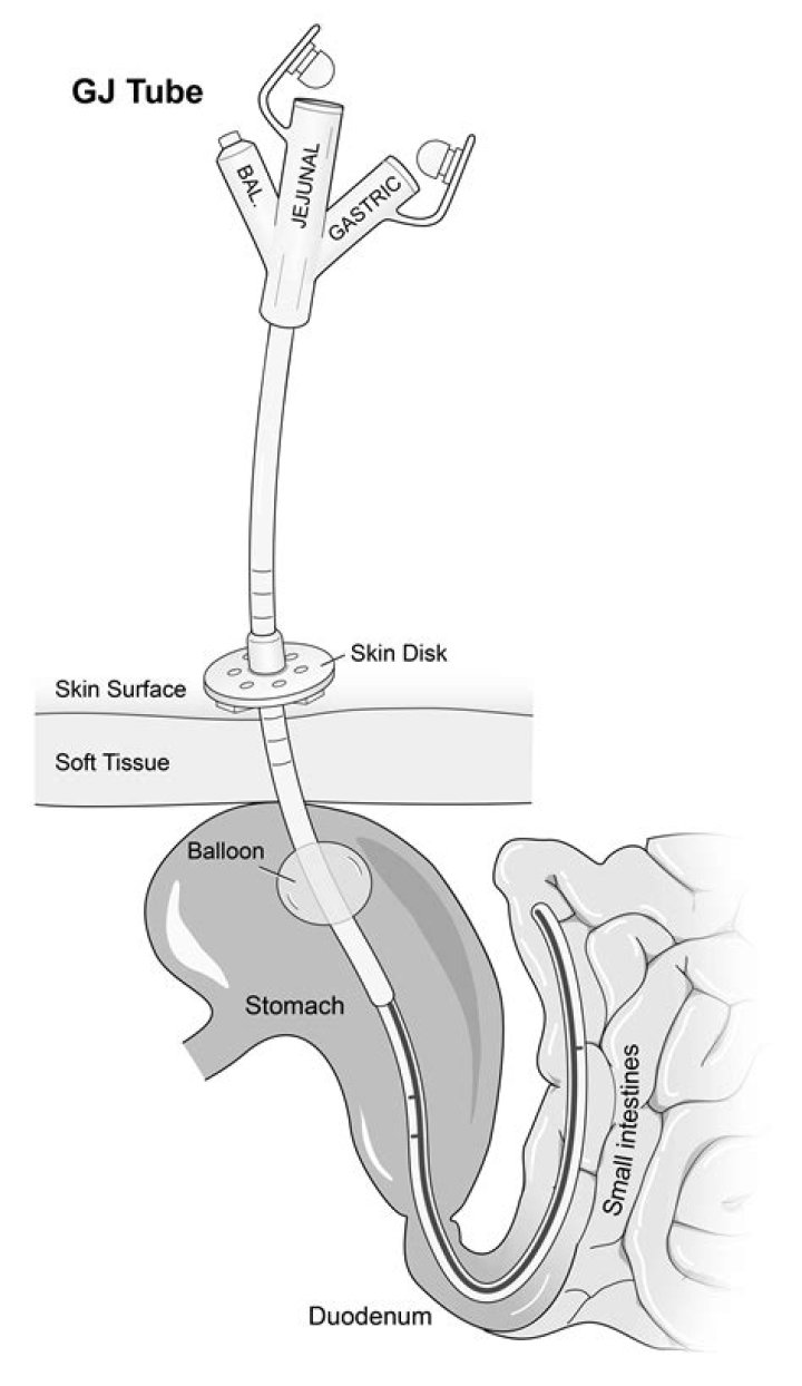 Is a GJ tube a PEG tube?