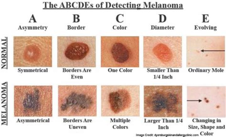 Is a severely atypical mole cancer?