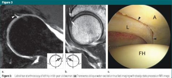 Is an arthrogram and MRI?
