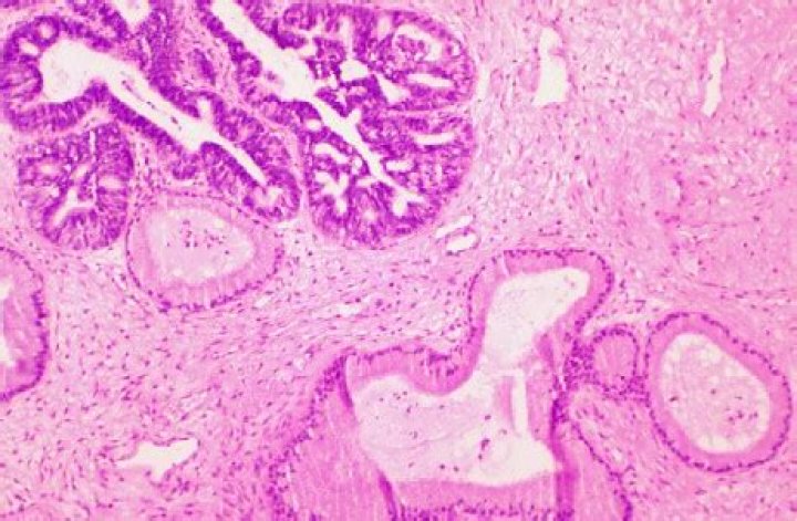 Is atypical glandular cells cancer?