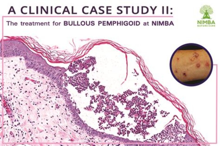 Is bullous pemphigoid curable?