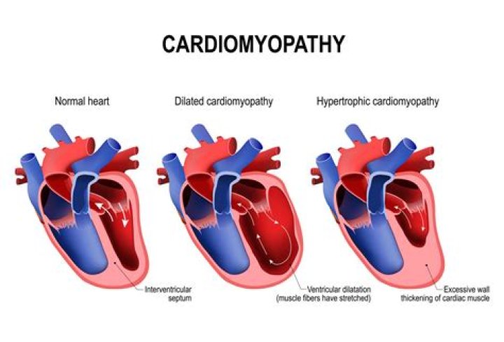 Is cardiomyopathy a congenital heart disease?