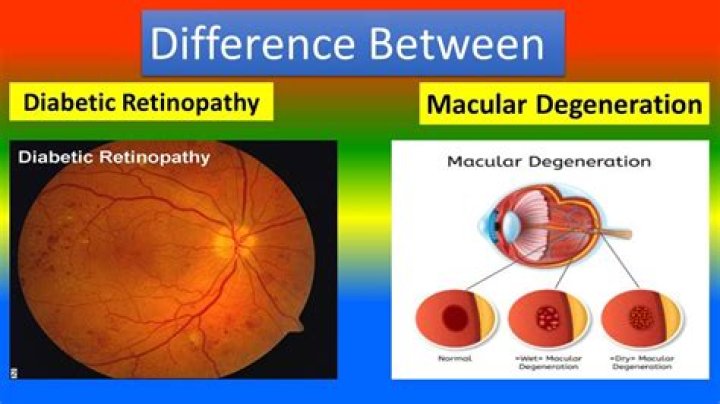 Is diabetic maculopathy the same as macular degeneration?