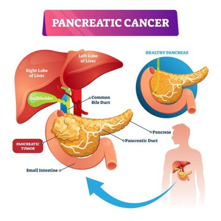 Is duodenal cancer the same as pancreatic cancer?