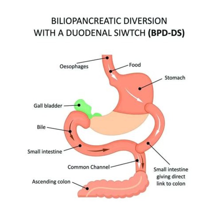 Is duodenal switch the same as gastric bypass?