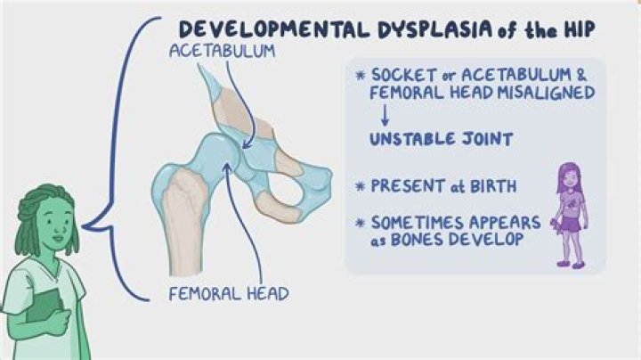 Is dysplasia the same as HPV?