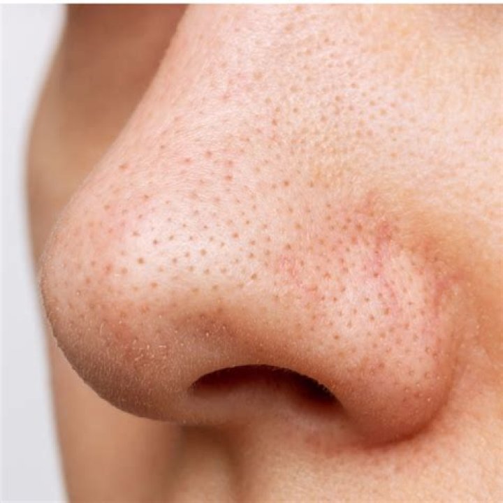 Is it bad to put tissue up your nose?