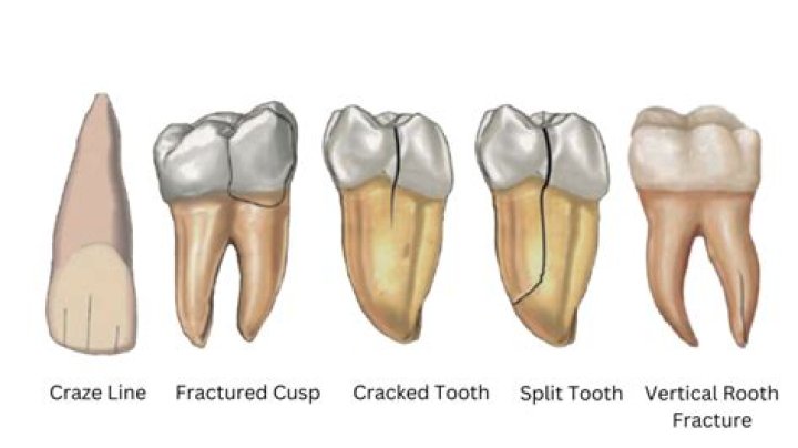 Is it easy to crack a tooth?