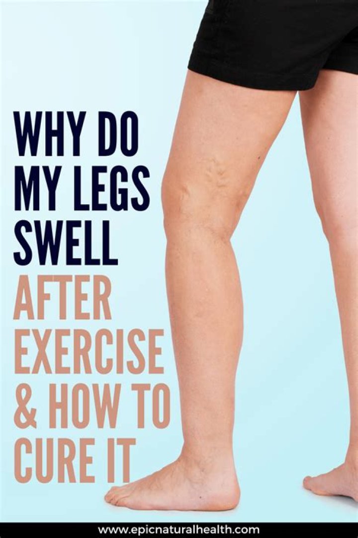 Is it normal for legs to swell after exercise?