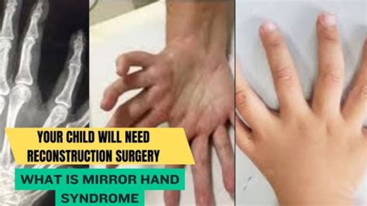 Is Mirror Hand Syndrome Real?