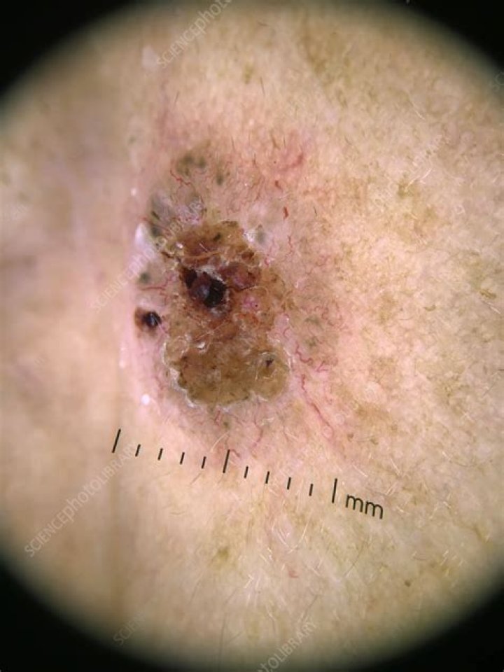 Is nodular basal cell carcinoma dangerous?