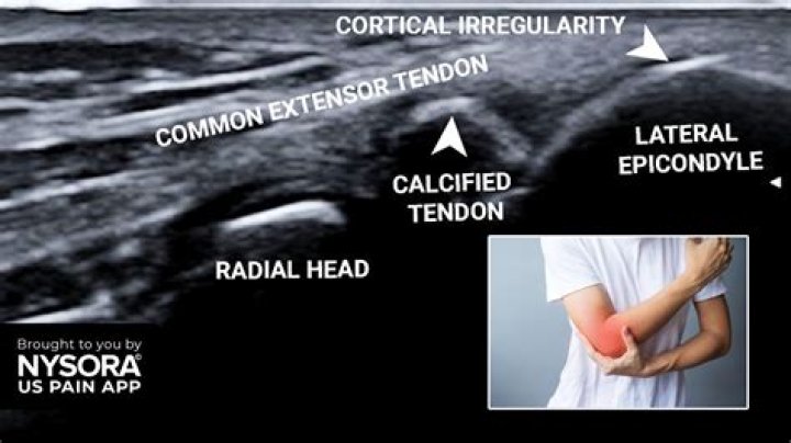 Is ultrasound good for tennis elbow?
