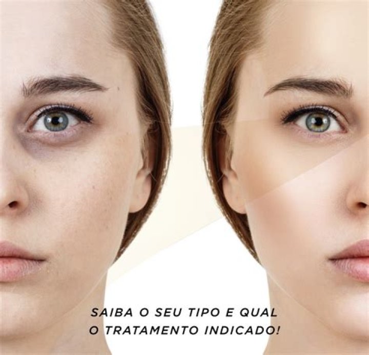O que fazer para evitar as olheiras?