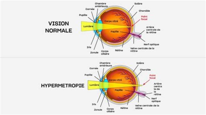 Quand porter ses lunettes quand on est Hypermetrope ?