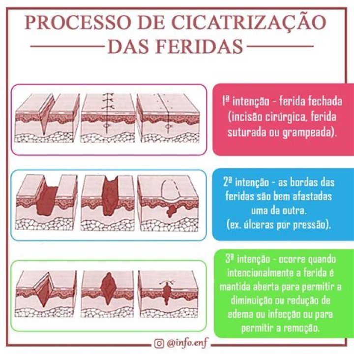 Quanto tempo demora para cicatrizar uma ferida aberta?