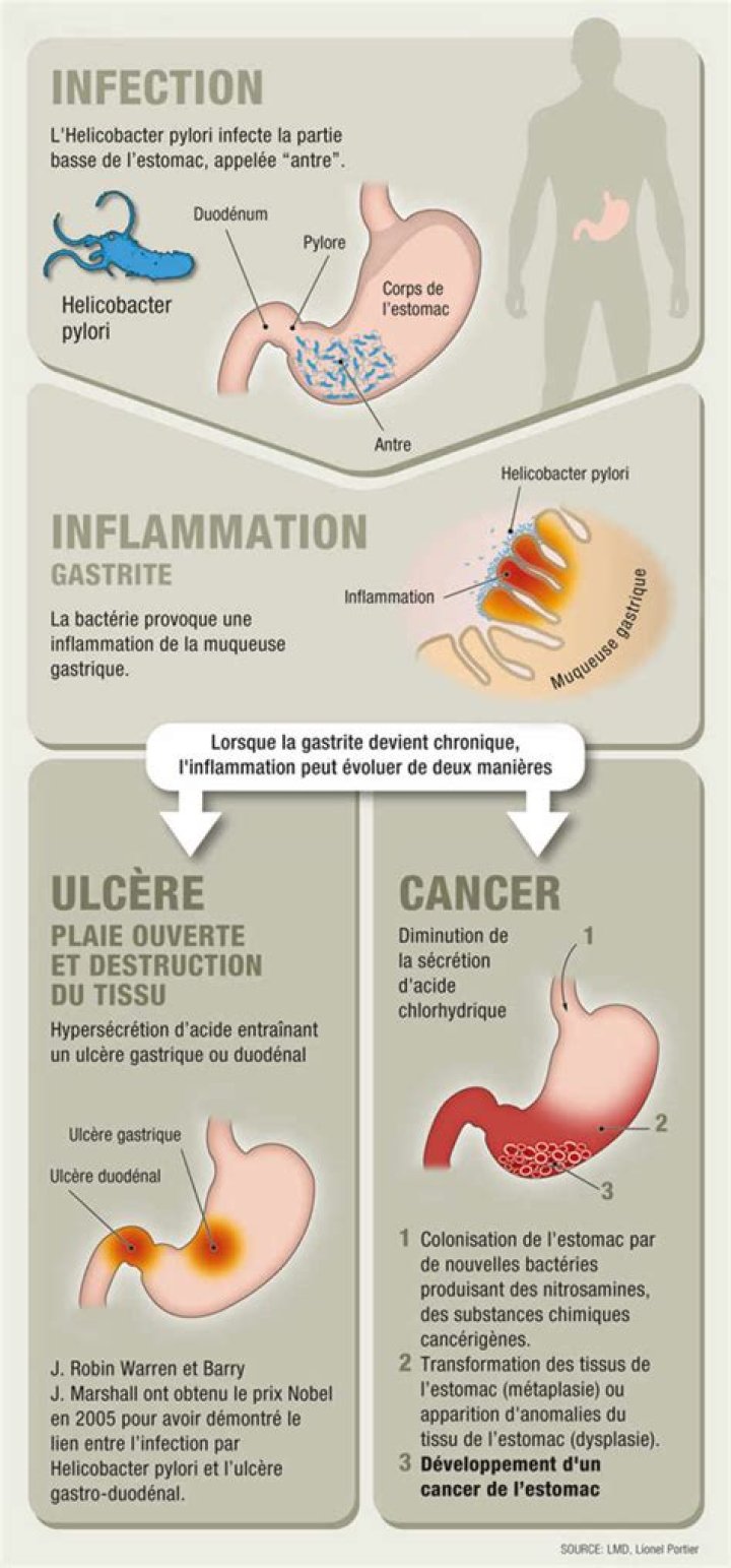 Quelle chance de survie avec un cancer de l'estomac ?
