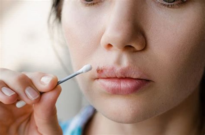 Quem tem herpes labial pode beijar na boca?