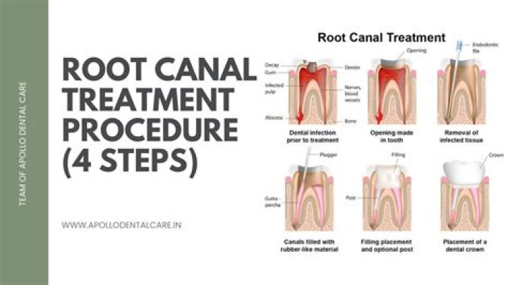 Should a root canal be done by a specialist?