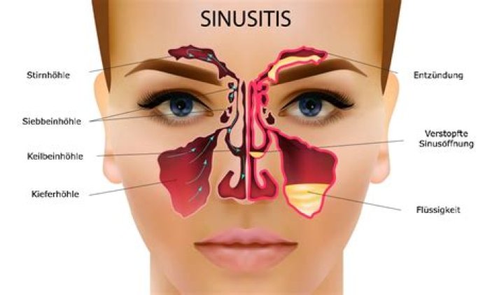 Wann ist eine Sinusitis ausgeheilt?